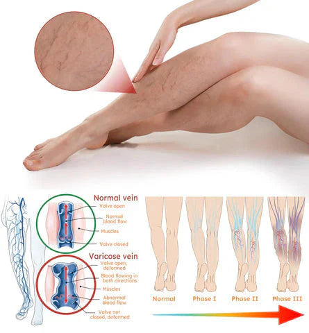 Varicose Veins Treatment Spray (Buy 1 Get 1 Free)