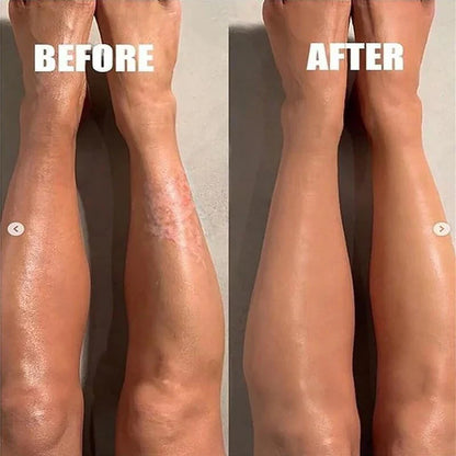 ORIGINAL Eczemaron Anti-Fungal Spray