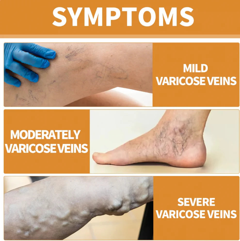 Varicose Veins Treatment Spray (Buy 1 Get 1 Free)