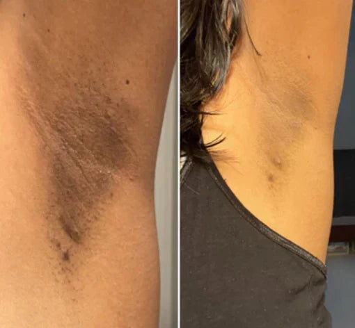 Peel Shot™ Skin Brightening Kojic Acid Turmeric Exfoliating Spray - old